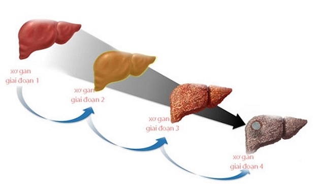Xơ gan cấp độ 2