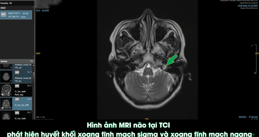 Huyết khối tĩnh mạch &#8211; Cục máu đông tĩnh mạch não nguy hiểm