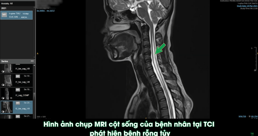 Bệnh rỗng tủy &#8211; căn bệnh rất hiếm gặp