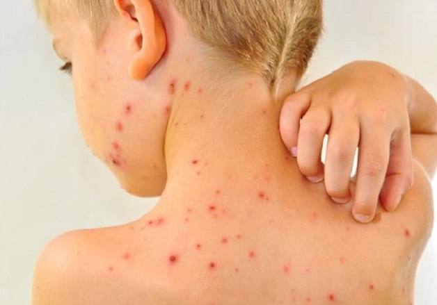 vắc xin sởi tiêm lúc nào