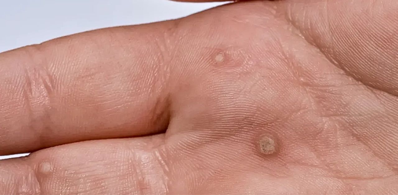 Các đường lây bệnh sùi mào gà và cách phòng tránh