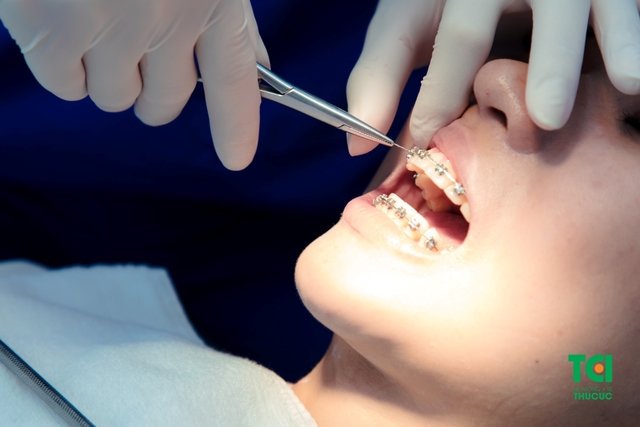 Chăm sóc răng sau niềng và sai lầm thường mắc