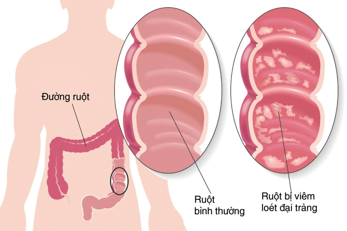 Chữa viêm đại tràng tại nhà như thế nào?