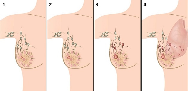 cách tầm soát ung thư vú