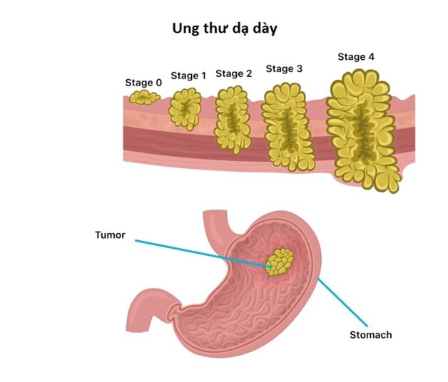 Phẫu thuật cắt dạ dày có sống được không