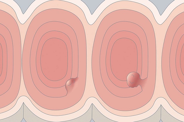 polyp đại trực tràng lớn có nguy cơ gây ung thư