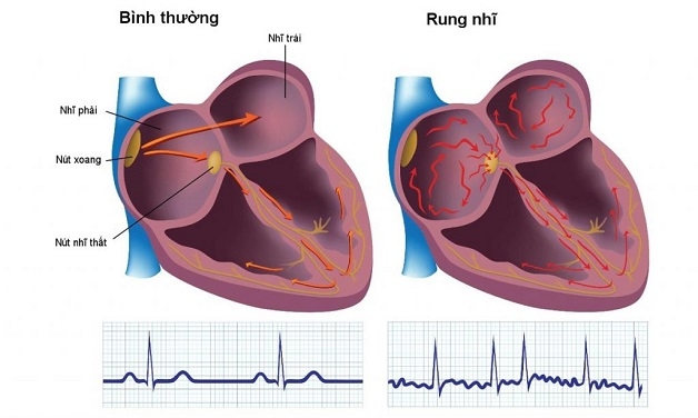 Rung nhĩ là dạng rối loạn nhịp nhanh dễ dẫn đến đột tử