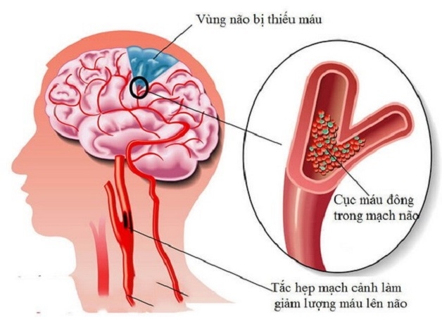 thiếu máu não thoáng qua TIA thường hồi phục trước 24 giờ. 