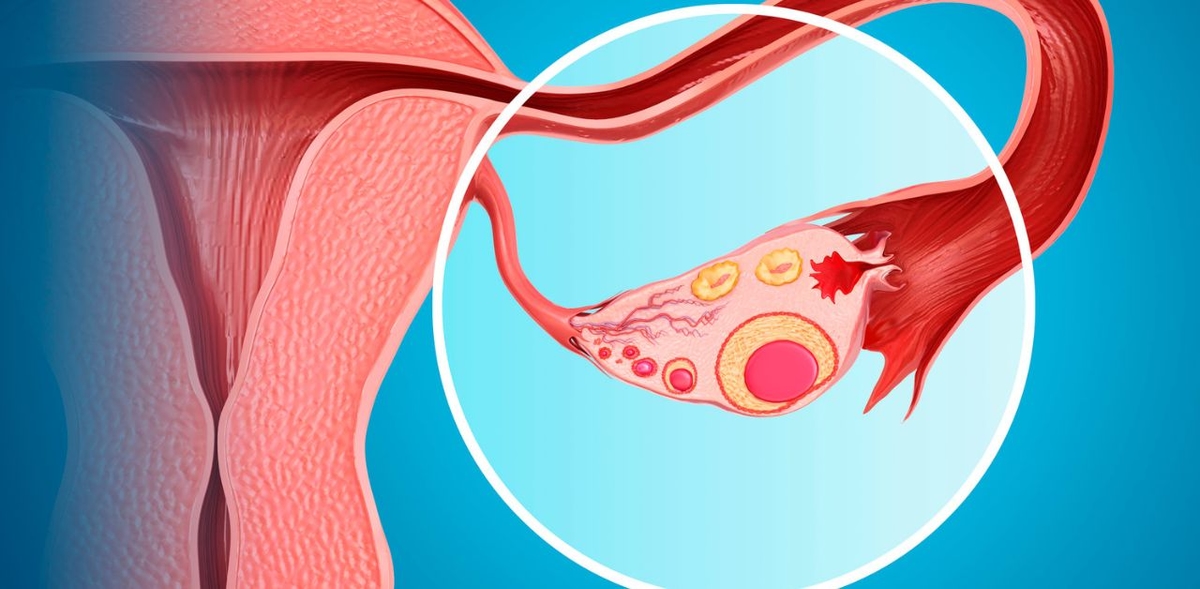 Tìm hiểu về bệnh u nang buồng trứng và cách điều trị