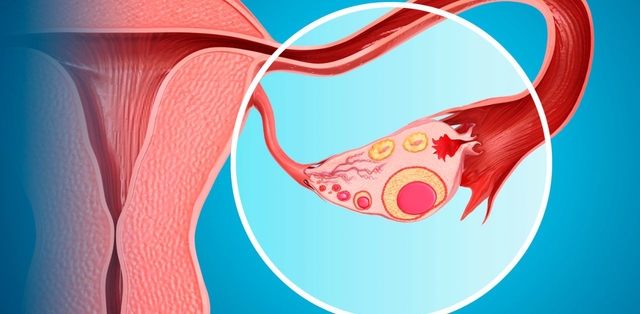 Tìm hiểu về bệnh u nang buồng trứng và cách điều trị