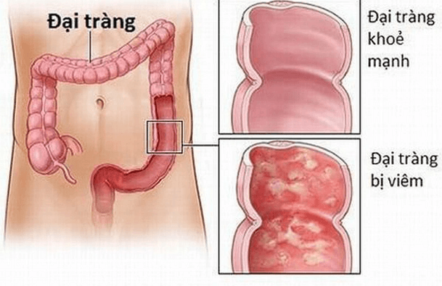 điều trị viêm đại tràng không xác định