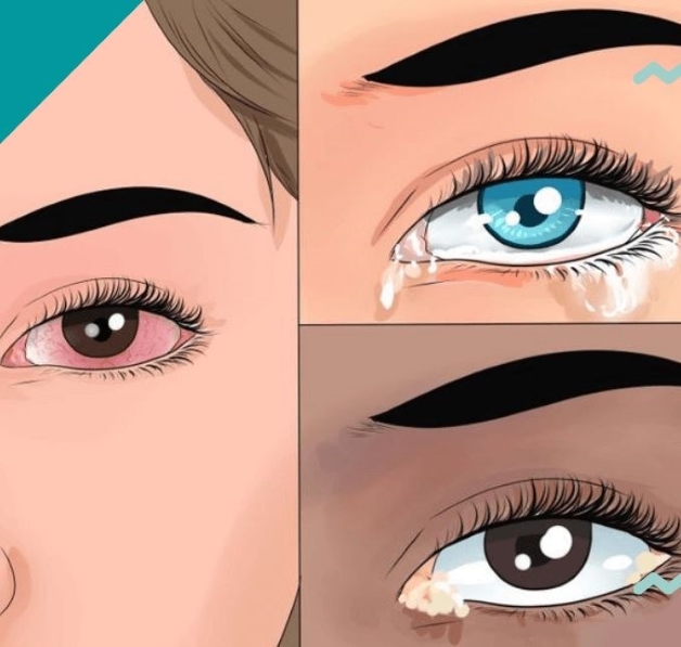 viêm kết giác mạc mùa xuân điều trị ra sao