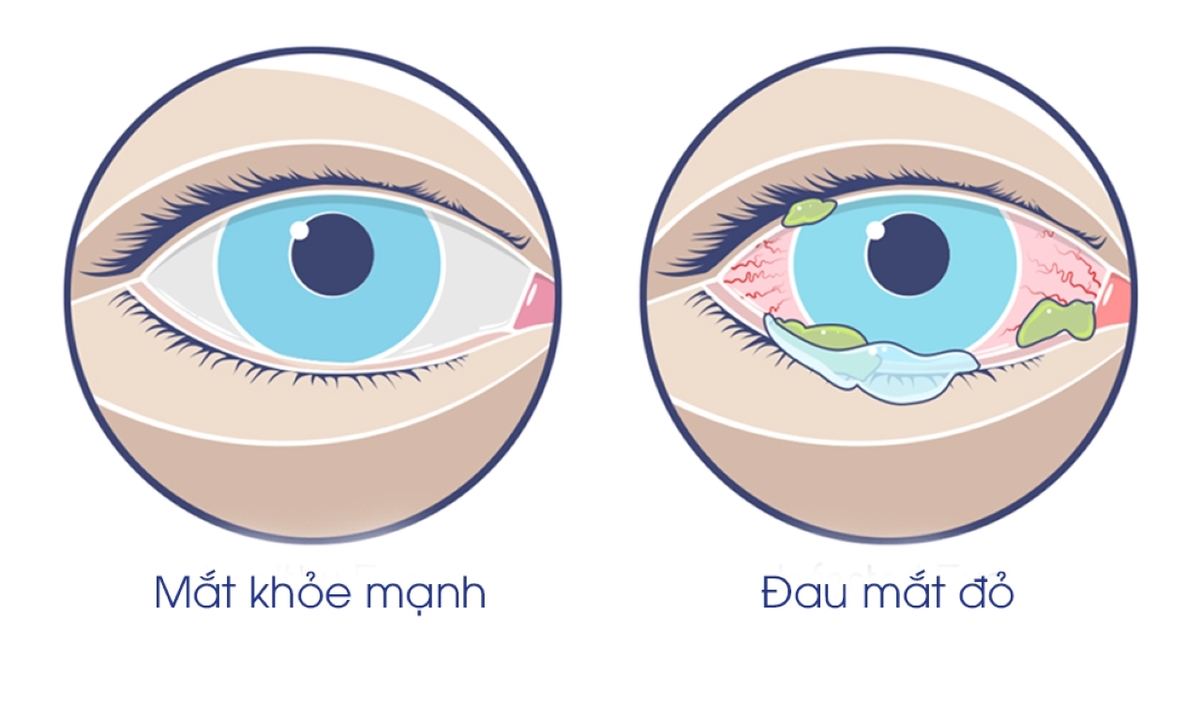Phương pháp điều trị bệnh viêm kết mạc cấp tính?