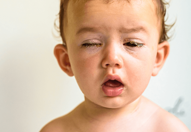 Ai cũng có thể bị viêm kết mạc, kể cả trẻ sơ sinh và trẻ nhỏ