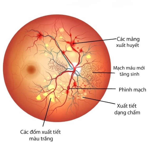 viêm kết mạc xuất huyết bao lâu khỏi