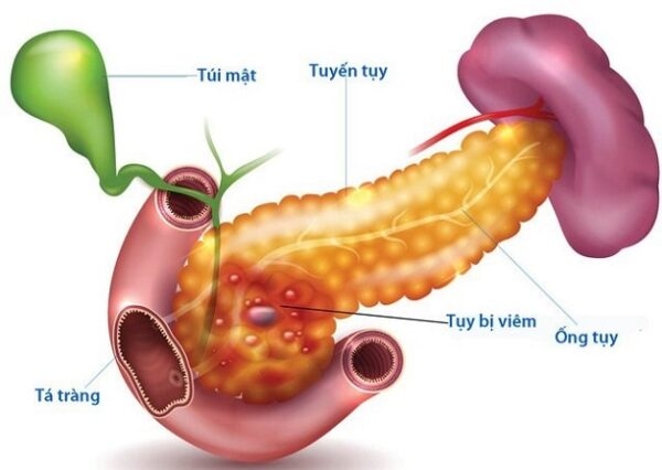 Viêm tụy cấp khiến người bệnh đau bụng, khó chịu, buồn nôn 