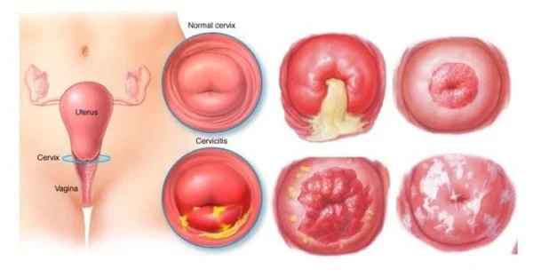 các giai đoạn của bệnh ung thư cổ tử cung biểu hiện thế nào?