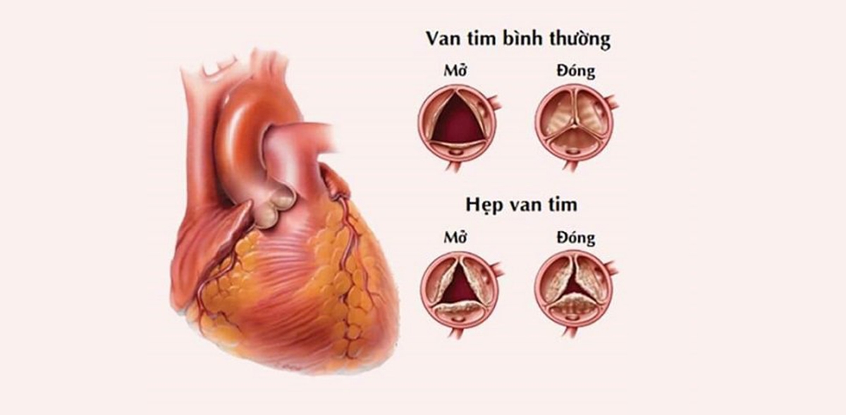 Hẹp van tim hai lá là gì? Triệu chứng và cách điều trị