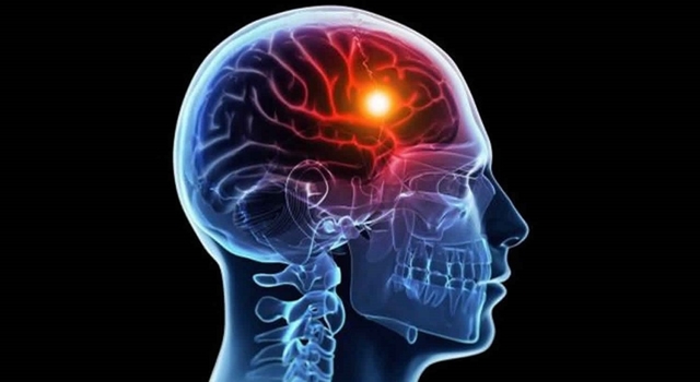 Cần làm gì khi phát hiện bị thiếu máu não?