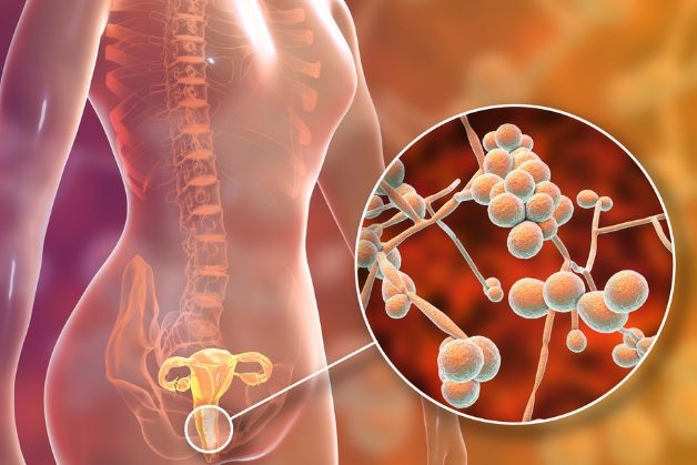 các triệu chứng của viêm âm đạo không thể bỏ qua