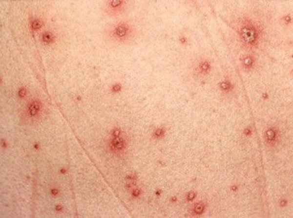 cách nhận biết bệnh thủy đậu