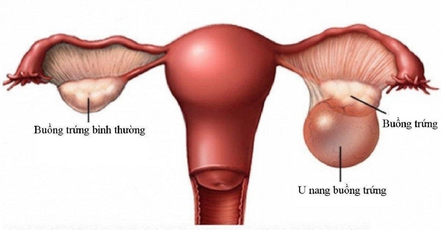 3 cách trị bệnh u nang buồng trứng hiệu quả, phổ biến hiện nay