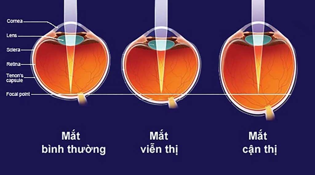 Cận thị và viễn thị là gì? Nguyên nhân và cách điều trị