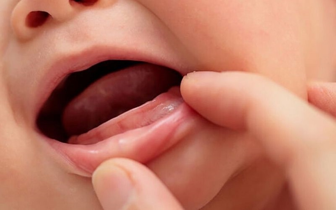 Tình trạng chậm mọc răng ở trẻ và cách khắc phục