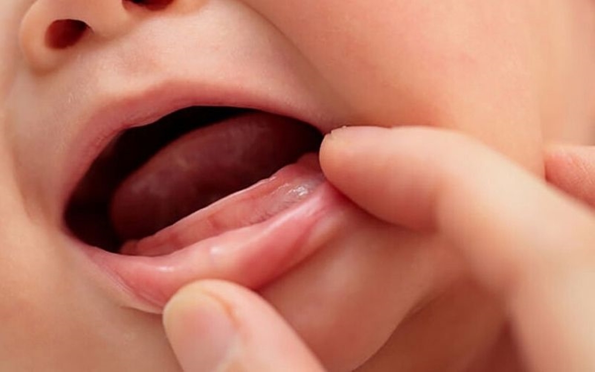 Tình trạng chậm mọc răng ở trẻ và cách khắc phục