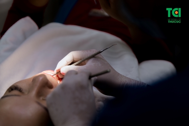 Dán sứ Veneer Emax