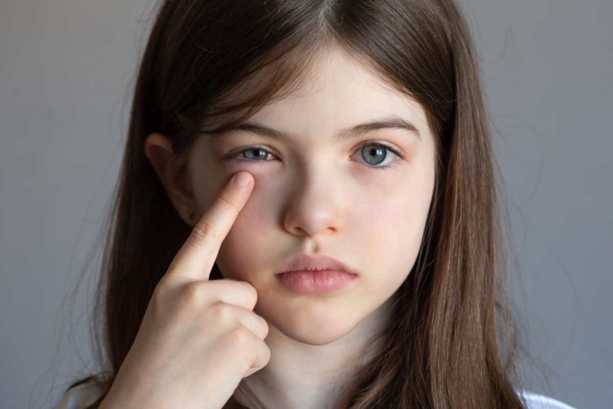 Giải đáp: Đau mắt đỏ uống kháng sinh gì?