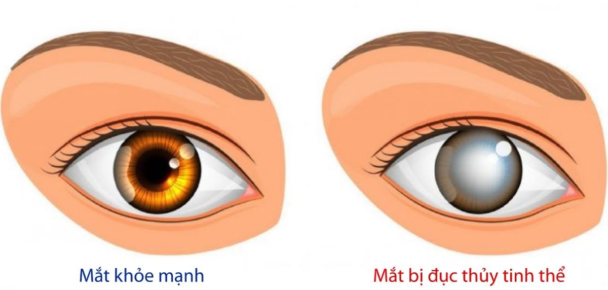 Điều trị bệnh lý đục thủy tinh thể ở người tiểu đường như thế nào?
