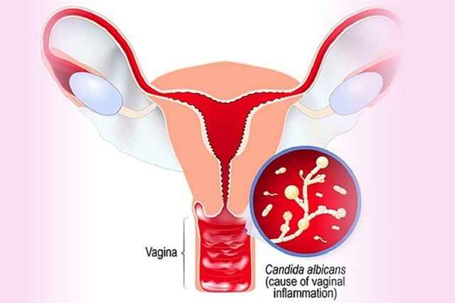 Nấm âm đạo mãn tính gây ra những ảnh hưởng gì?