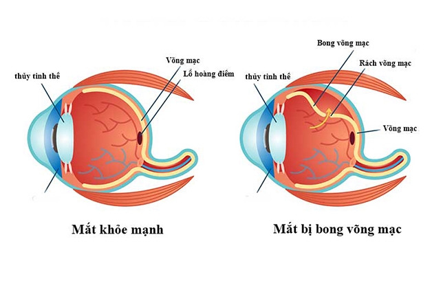 rách võng mạc