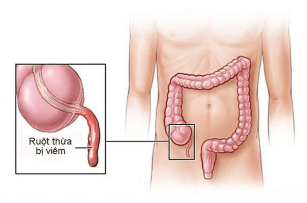 Viêm ruột thừa gây triệu chứng của đau ruột thừa