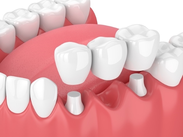 Thiếu mầm răng vĩnh viễn