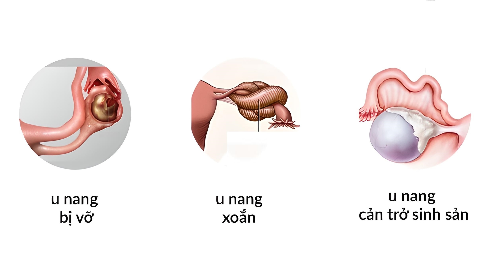 U nang buồng trứng có thể phát triển và gây ra những biến chứng nguy hiểm nếu không được xử trí sớm