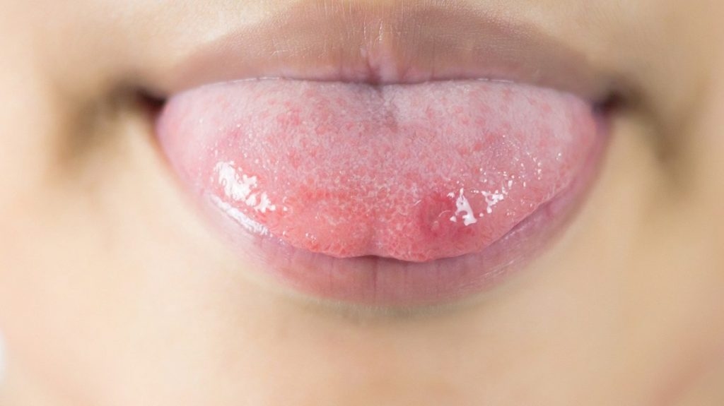 Tìm hiểu các triệu chứng ung thư lưỡi giai đoạn đầu