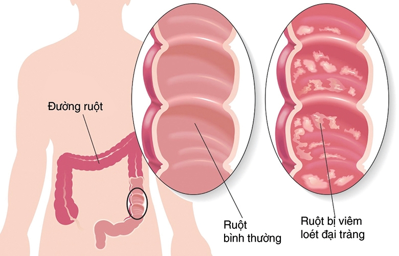 Hình ảnh viêm đại tràng màng giả