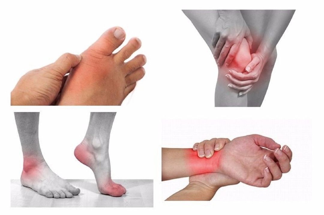 Những điều cần biết về bệnh viêm khớp cấp 