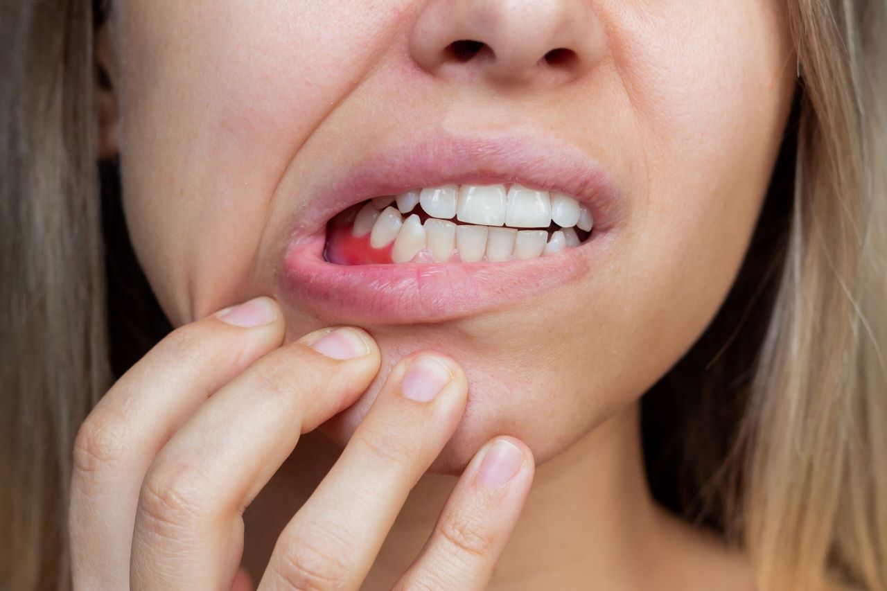 Dấu hiệu nhận biết và cách điều trị bệnh viêm nha chu