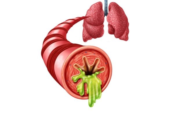 Viêm phế quản cấp là bệnh lý đường hô hấp thường gặp ở trẻ em