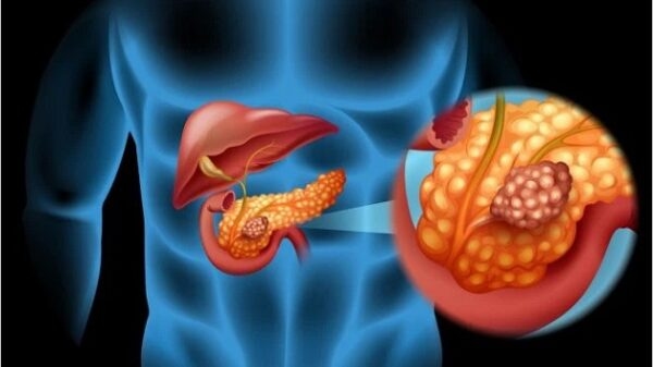 Bệnh viêm tụy cấp nên ăn gì? 