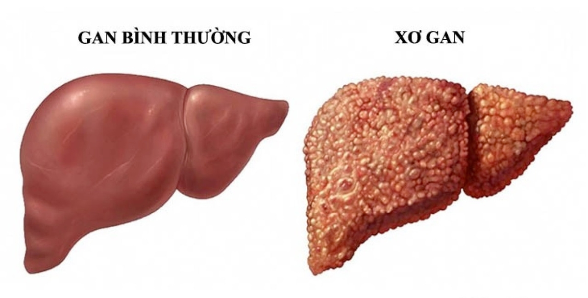 Xơ gan có mấy giai đoạn? Dấu hiệu từng giai đoạn như thế nào? 