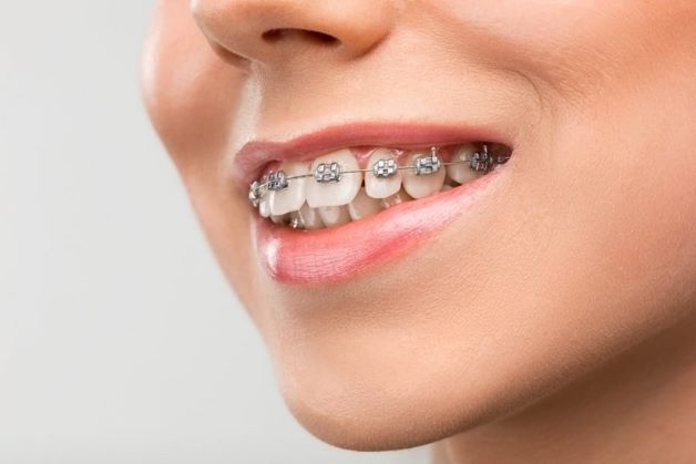 niềng răng thưa bao lâu
