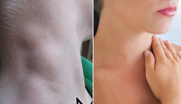 ung thư vòm họng có lây không?