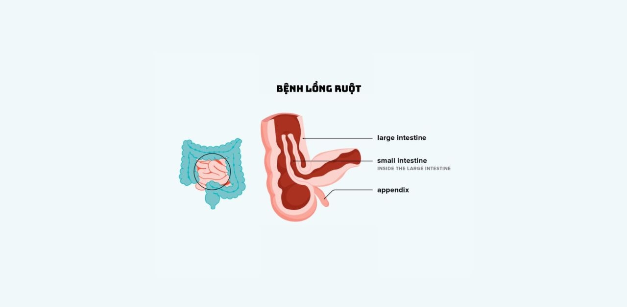 Lồng ruột ở trẻ em: Nguyên nhân, triệu chứng, cách xử trí