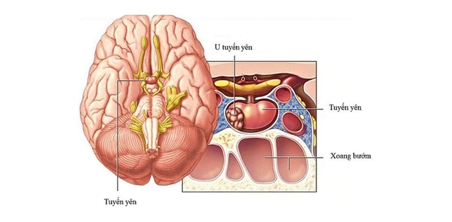 Dấu hiệu u tuyến yên và cách điều trị