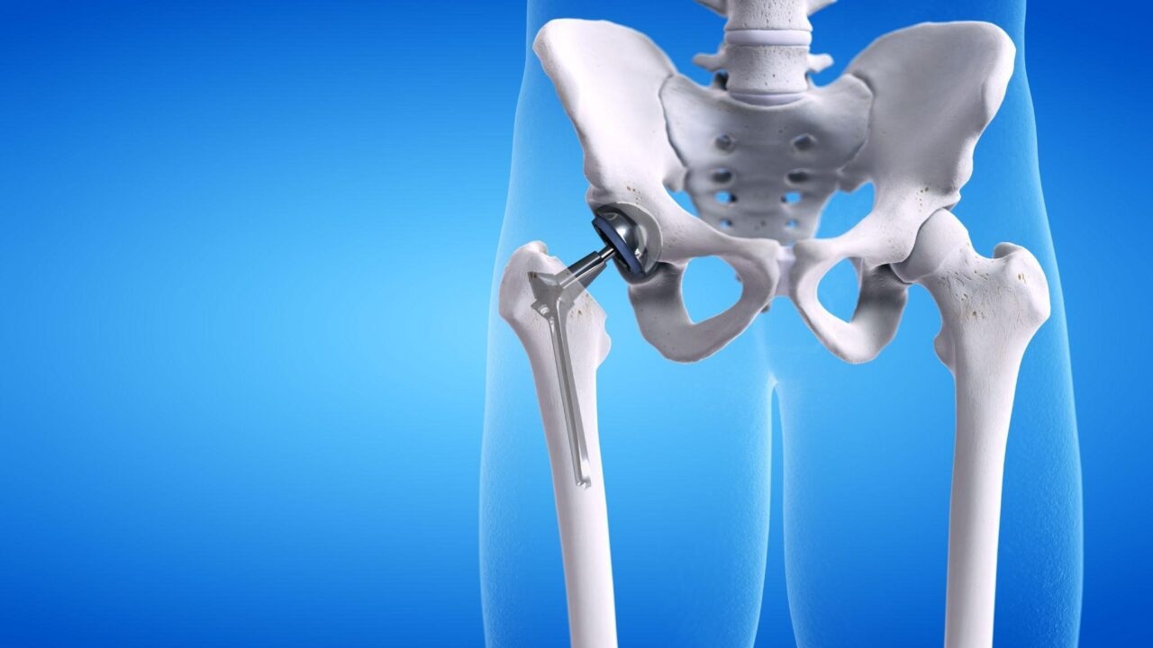Viêm khớp háng có triệu chứng gì và điều trị ra sao?