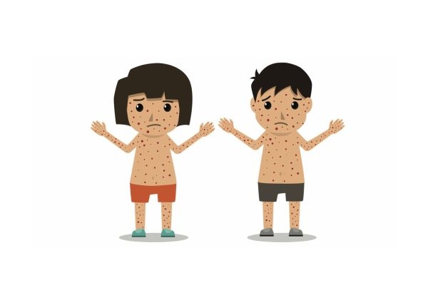 Sởi là bệnh truyền nhiễm cấp tính thường lây truyền qua đường hô hấp ở cả người lớn và trẻ nhỏ